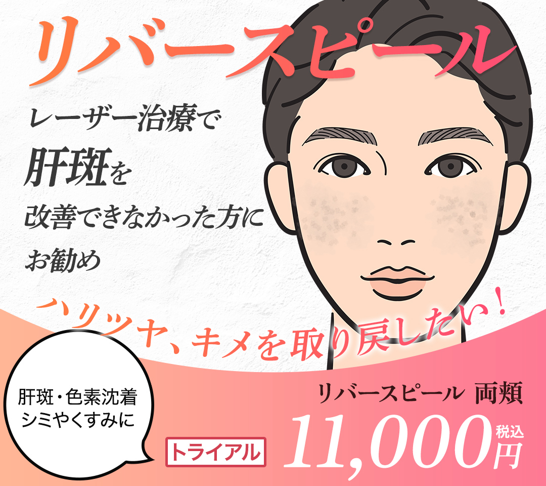 リバースピール