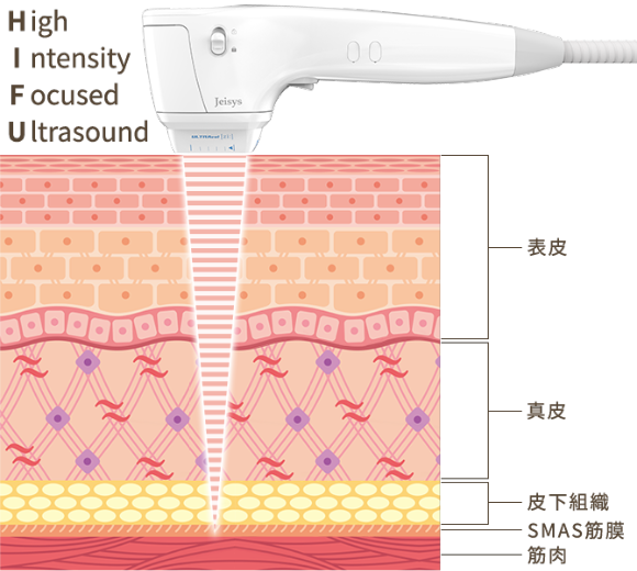 HIFU（ハイフ）とは？