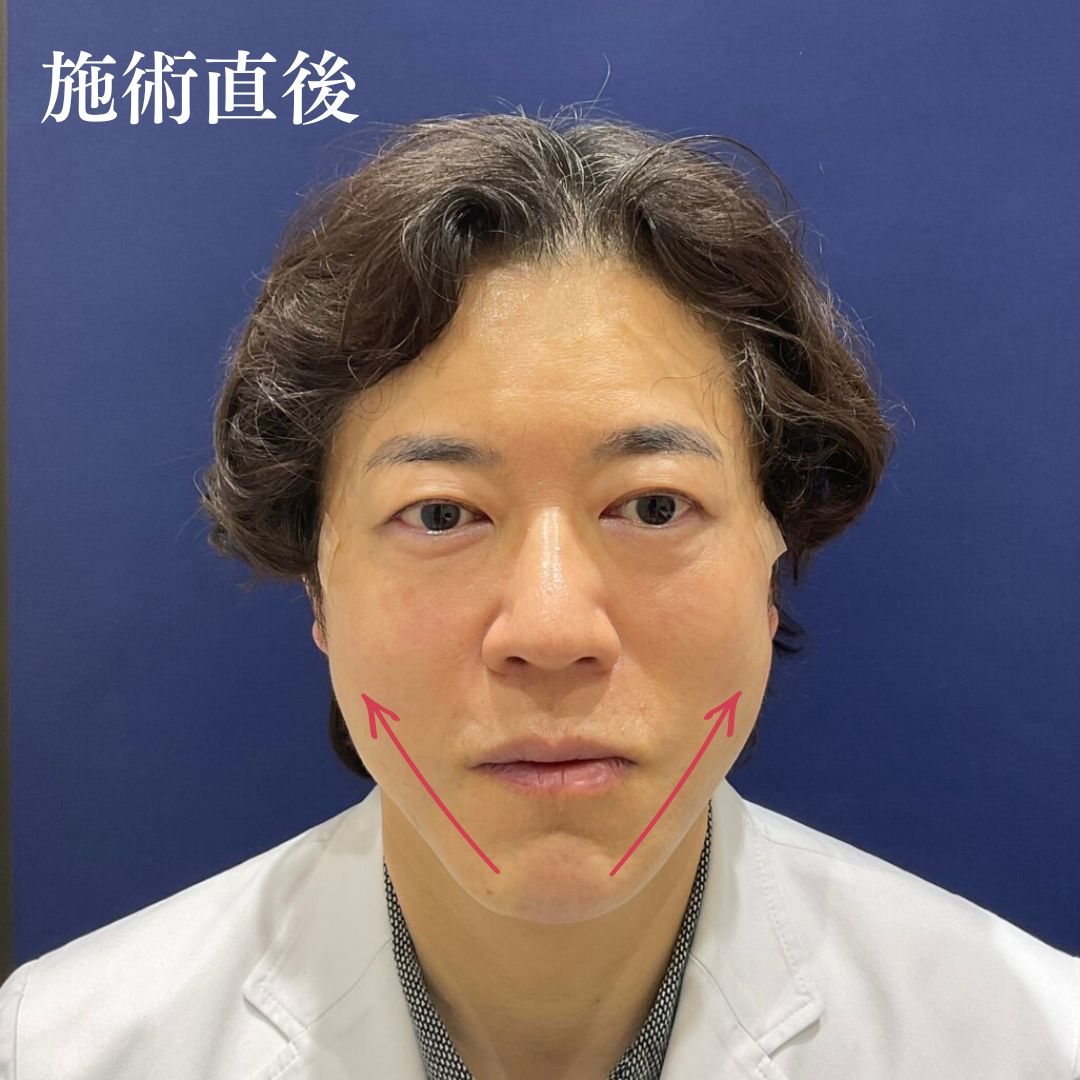 フェイスラインのたるみを改善したい、ほうれい線を薄くしたい