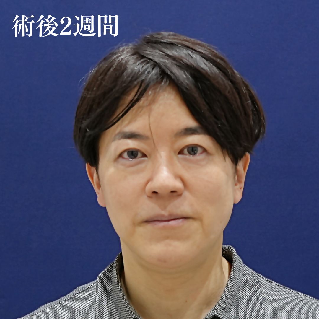 フェイスラインのたるみを改善したい、ほうれい線を薄くしたい