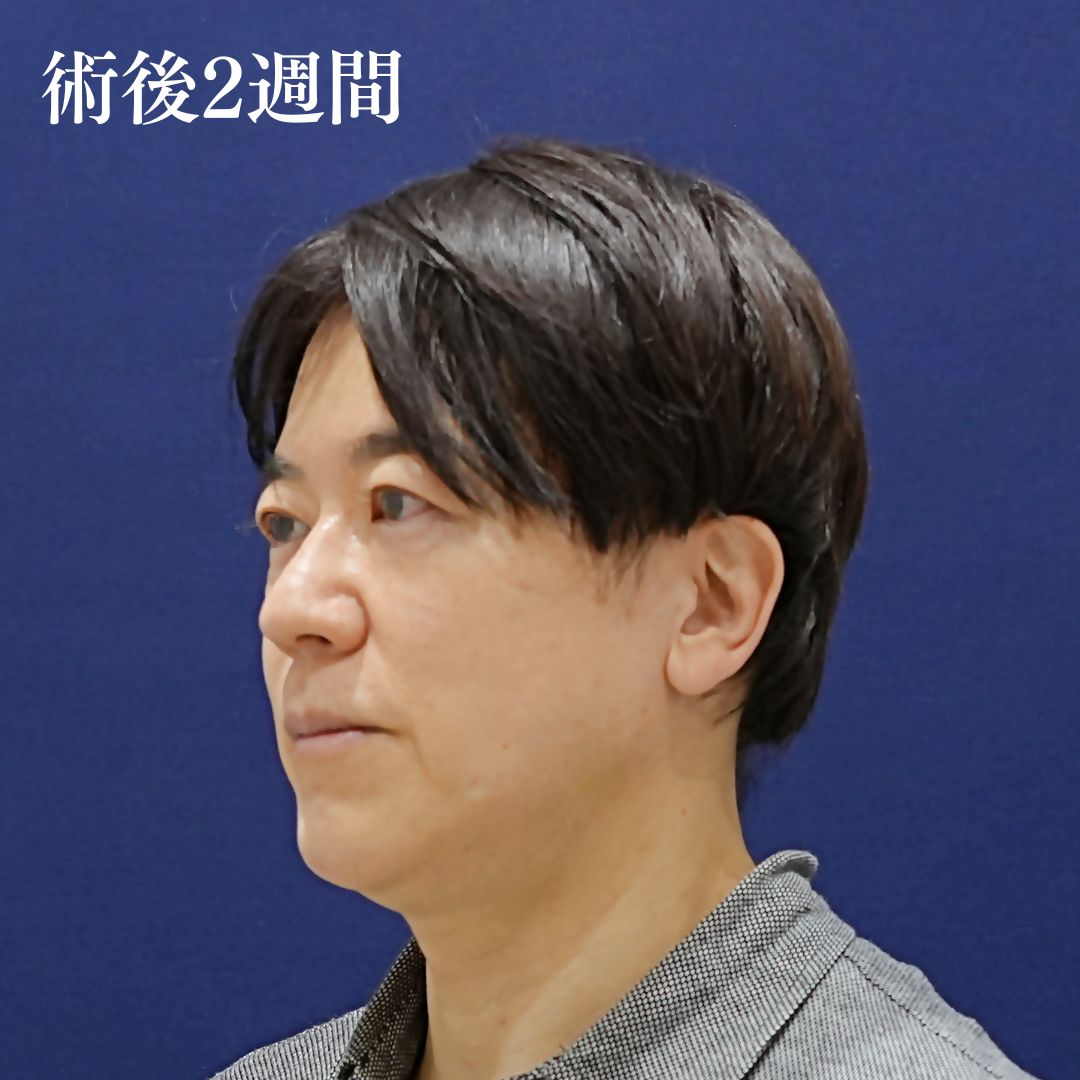 フェイスラインのたるみを改善したい、ほうれい線を薄くしたい