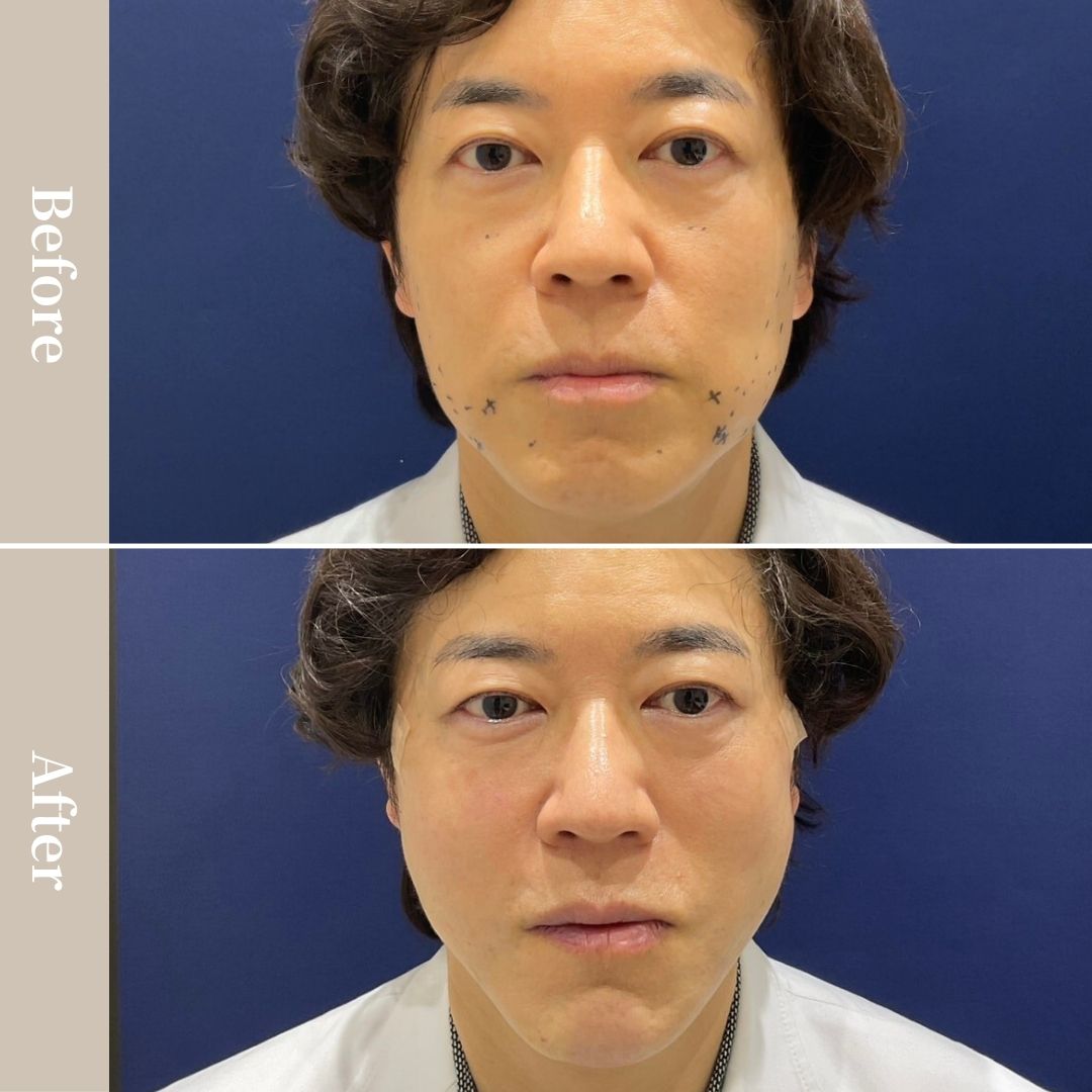 フェイスラインのたるみを改善したい、ほうれい線を薄くしたい