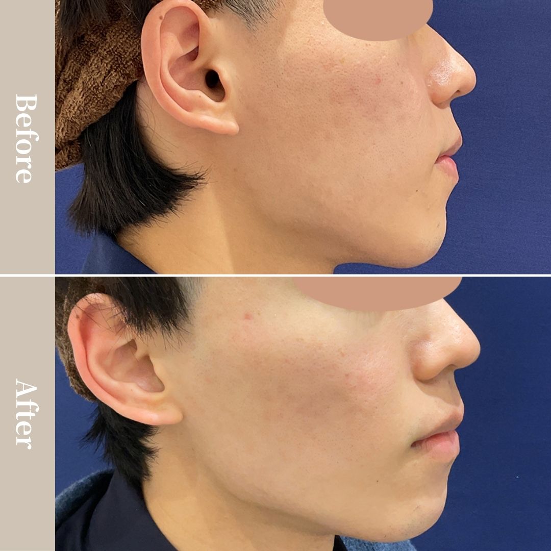 光に当たった時などの肌の凹凸感を治したい