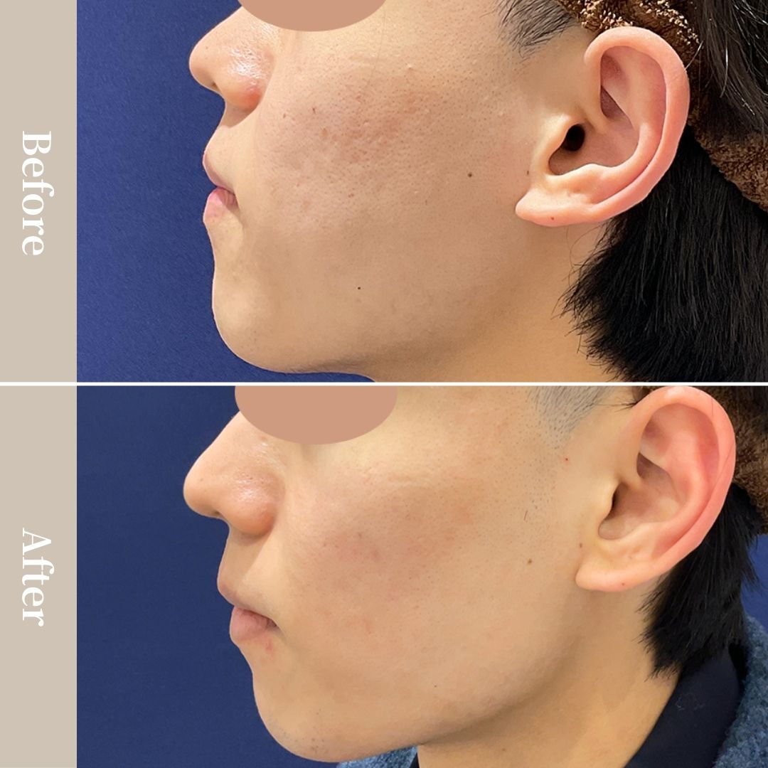 光に当たった時などの肌の凹凸感を治したい