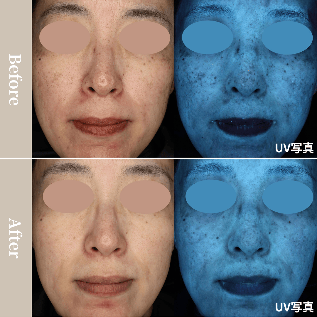 シミ、くすみ、肝斑（両頬骨外側）の治療