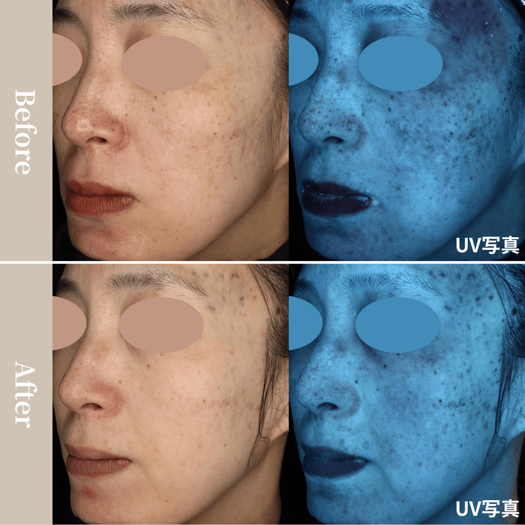 シミ、くすみ、肝斑（両頬骨外側）の治療