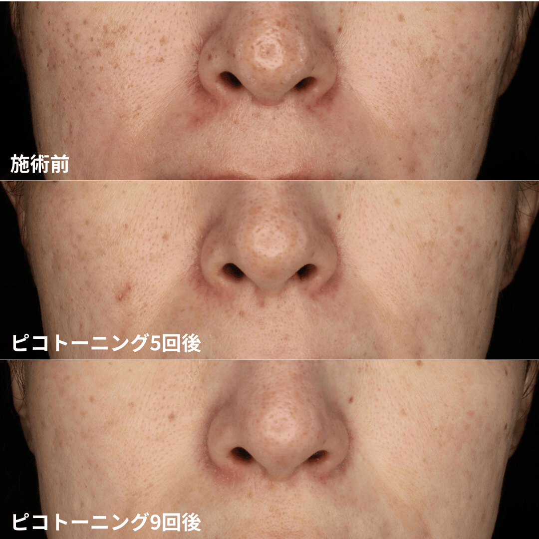 シミ、くすみ、肝斑（両頬骨外側）の治療